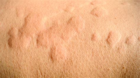 scratch test hives|dermatologist for hives.